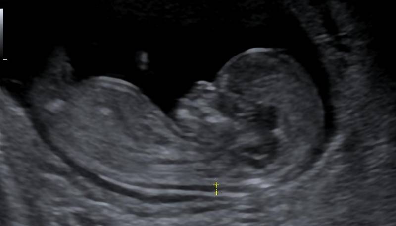 échographie obstétricale du premier trimestre de la grossesse chez la femme enceinte a Roanne