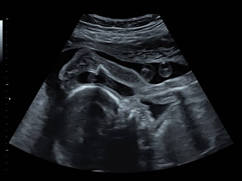 échographie de grossesse morphologique du deuxième trimestre sans ordonnance a Bron