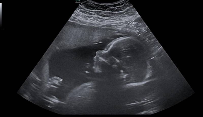 échographie obstétricale de la grossesse chez la femme enceinte Bayonne